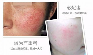 红血丝怎样去除（红血丝怎么去除）