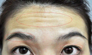 抬头纹很重怎么办 四十岁的女人抬头纹很重怎么办
