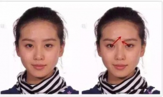 斜视怎么办（有一只眼睛斜视怎么办）