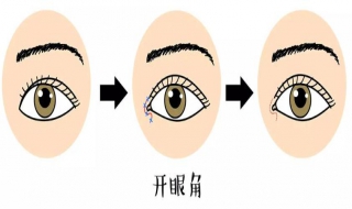 开眼角失败怎么避免 开眼角失败怎么避免留疤痕