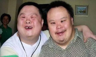 唐氏综合征的面貌 唐氏综合征的面貌表现
