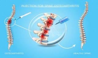 脊柱关节炎的早期症状是什么 脊柱关节炎有什么主要症状