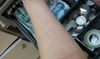 寻麻的症状和治疗方法 荨麻的症状和治疗方法